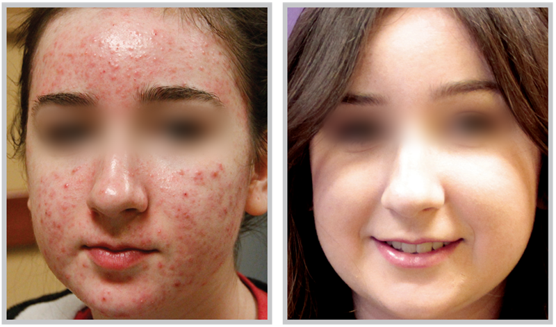 BBL Forever Clear acne treatment Before and After