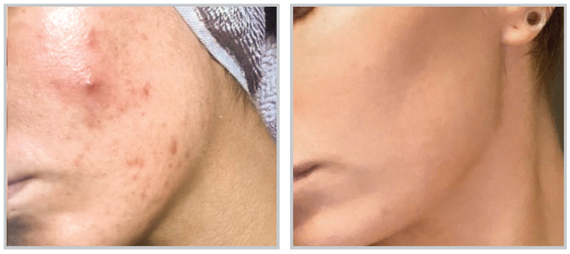 BBL Forever Clear acne treatment Before and After