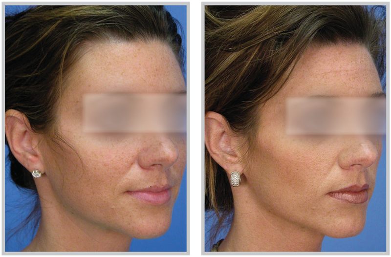 Sciton Micro Laser Peel Before After
