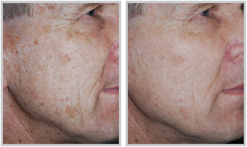 Sciton Micro Laser Peel Before After